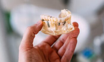 hand holding dental model teeth implants