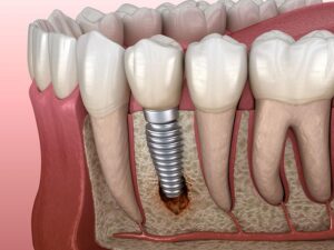  Dental Implant Isn't Healing Properly