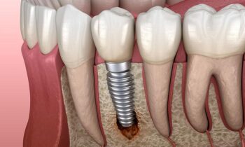 Dental Implant Fails