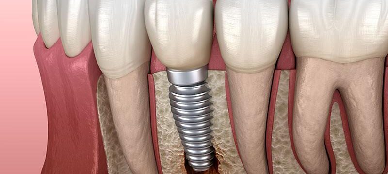 Dental Implant Fails