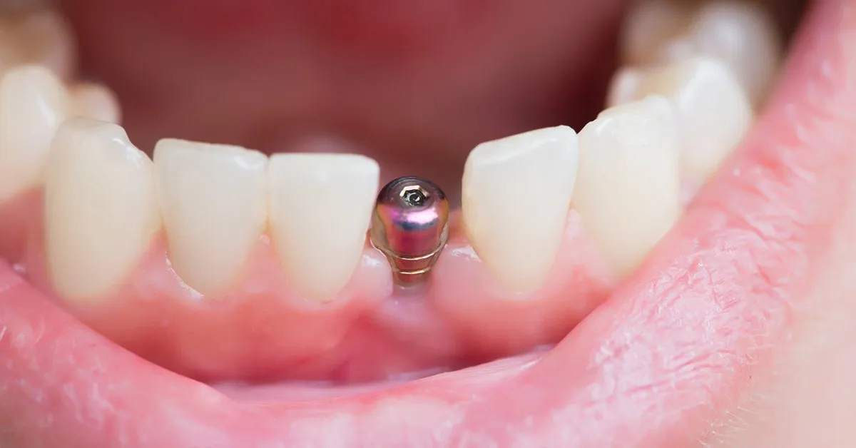 dental implant healing