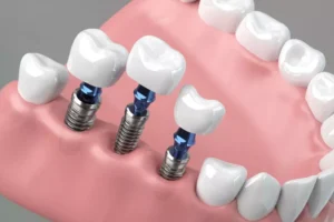 a dental implant in Rockville, MD