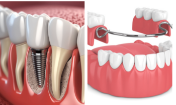 Choosing the Right Dental Implant and Dentures Solutions for a Perfect Smile