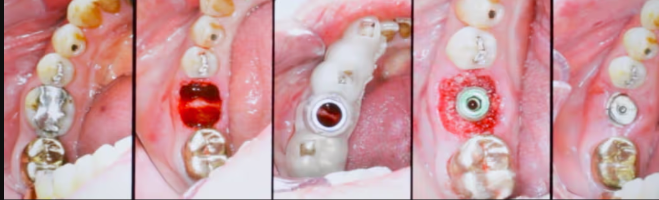 Dental Implant Healing Stages Rockville MD Guide