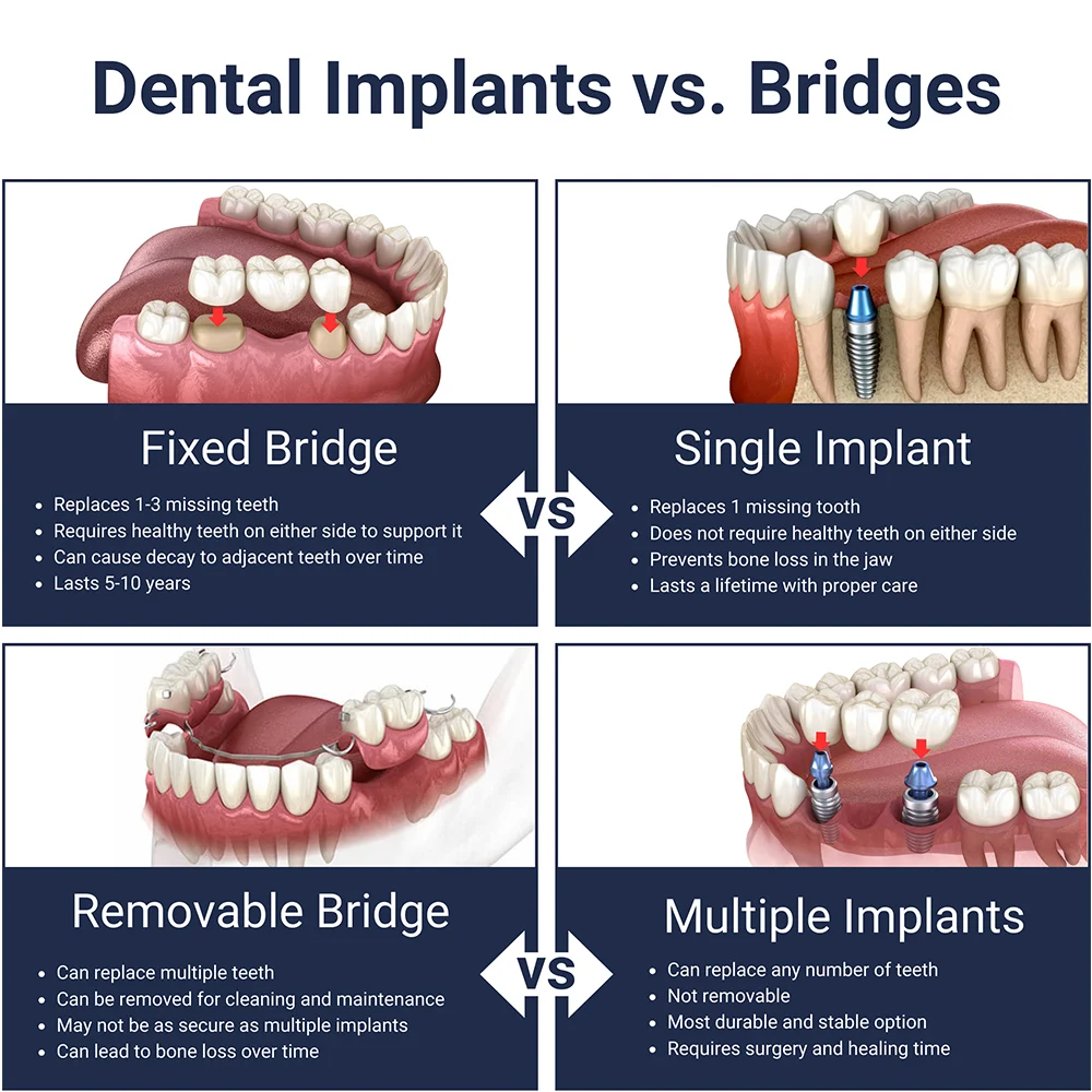 dental-bridges-vs-dental-implants