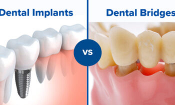 dental-bridges-vs-dental-implants