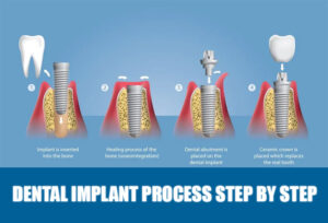dental implant process step by step