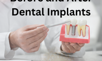 Before and after images of dental implants, highlighting improved smiles.