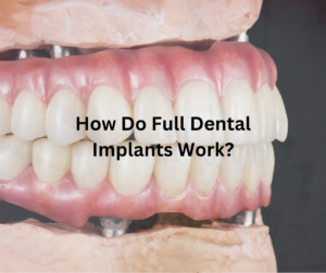 The Process of Getting Fixed Implant Dentures