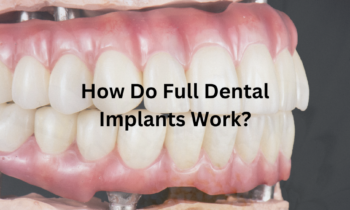 Visual representation of full dental implants, showing the procedure, healing phases, and completed restoration.