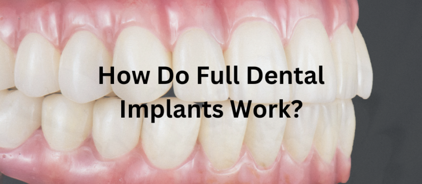 Visual representation of full dental implants, showing the procedure, healing phases, and completed restoration.