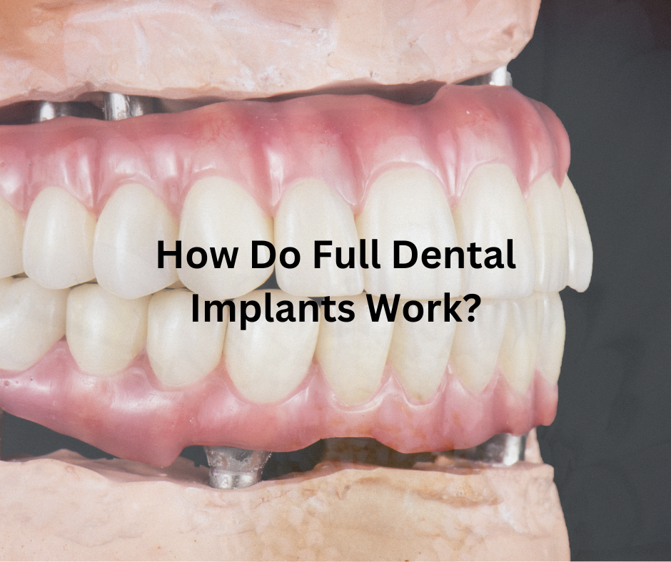 Visual representation of full dental implants, showing the procedure, healing phases, and completed restoration.