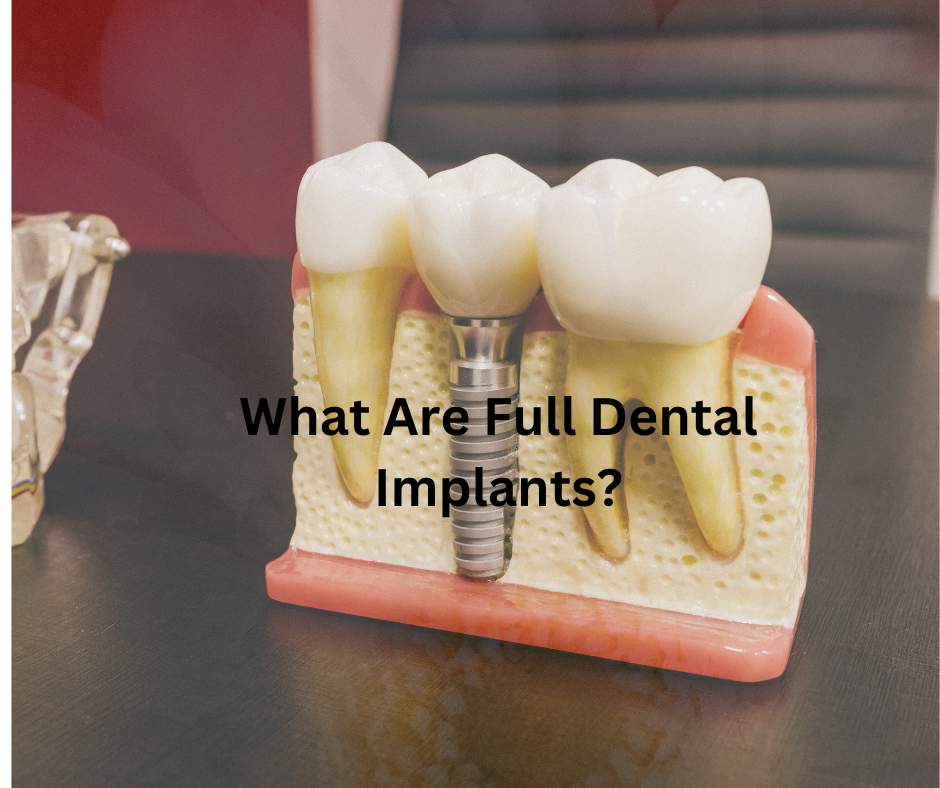 A visual representation of full dental implants, emphasizing their role in improving aesthetics and function.