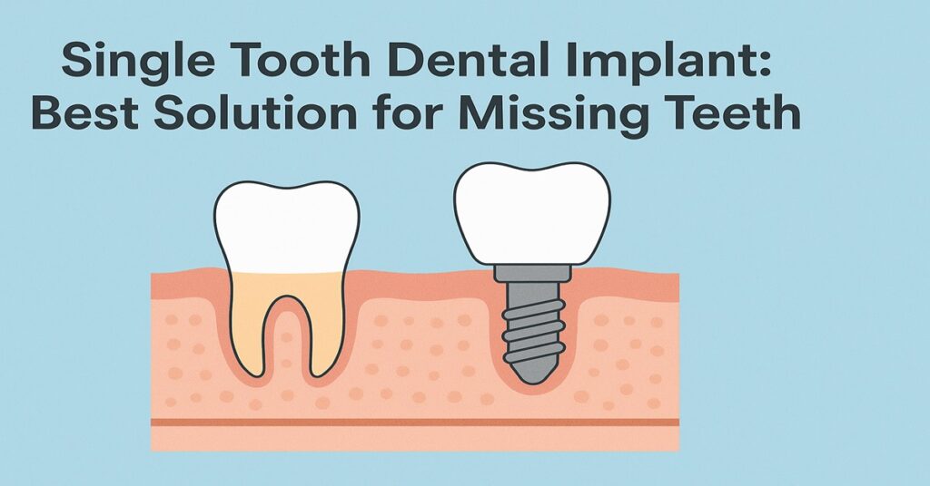 Single Tooth Dental Implant Best Solution for Missing Teeth