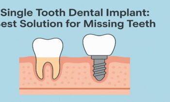 Single Tooth Dental Implant Best Solution for Missing Teeth
