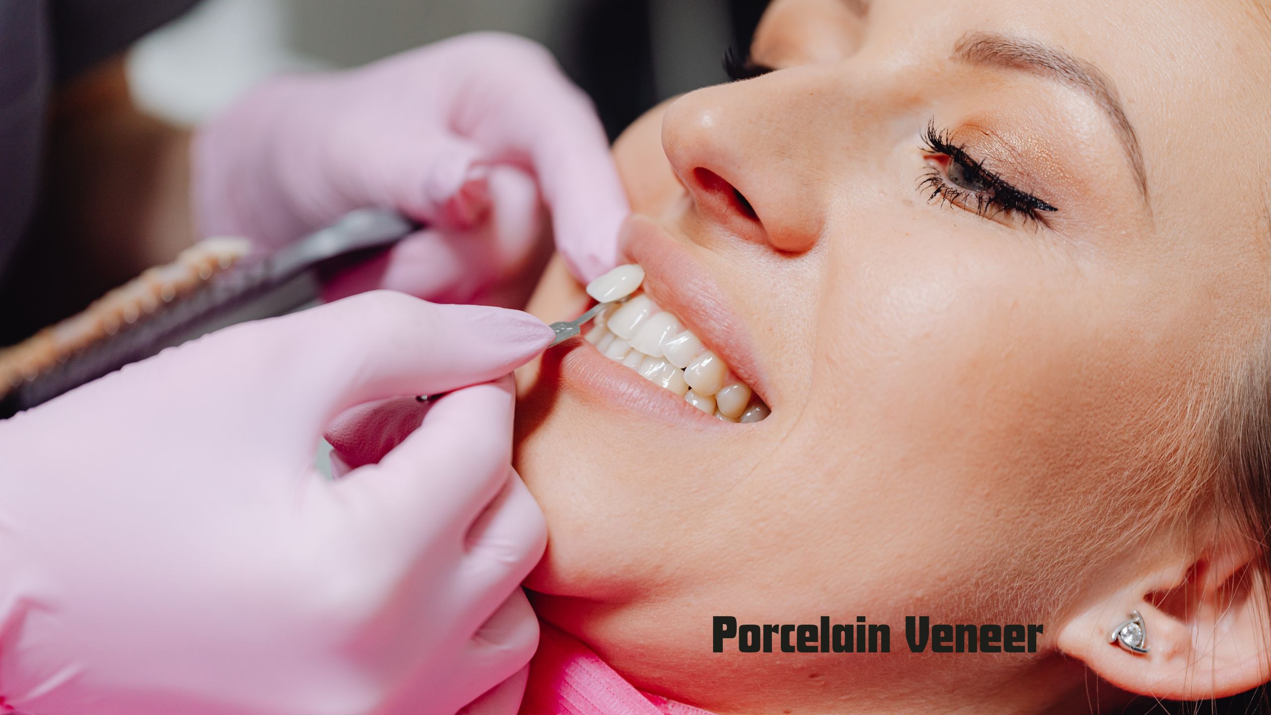 porcelain veneer alternatives