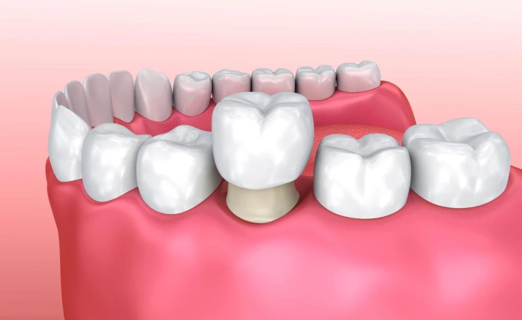 3D Image of dental crowns rockville md