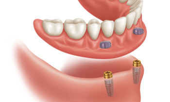 snap in dentures