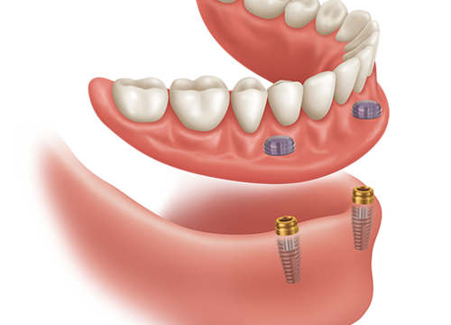 snap in dentures