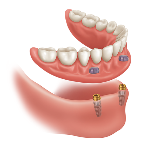 snap in dentures