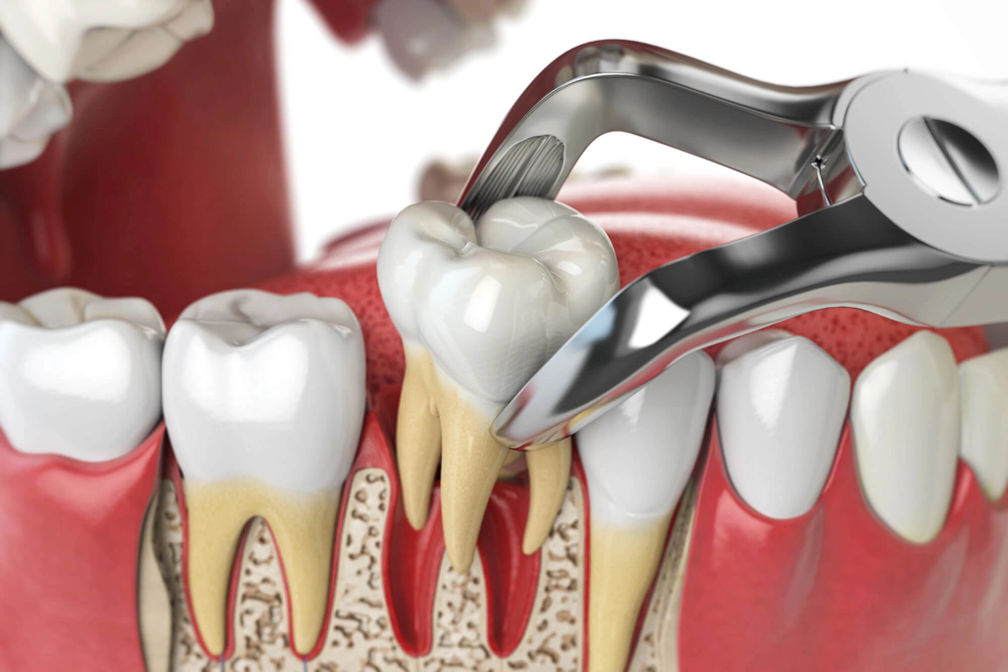 3D Illustration of tooth extraction rockville