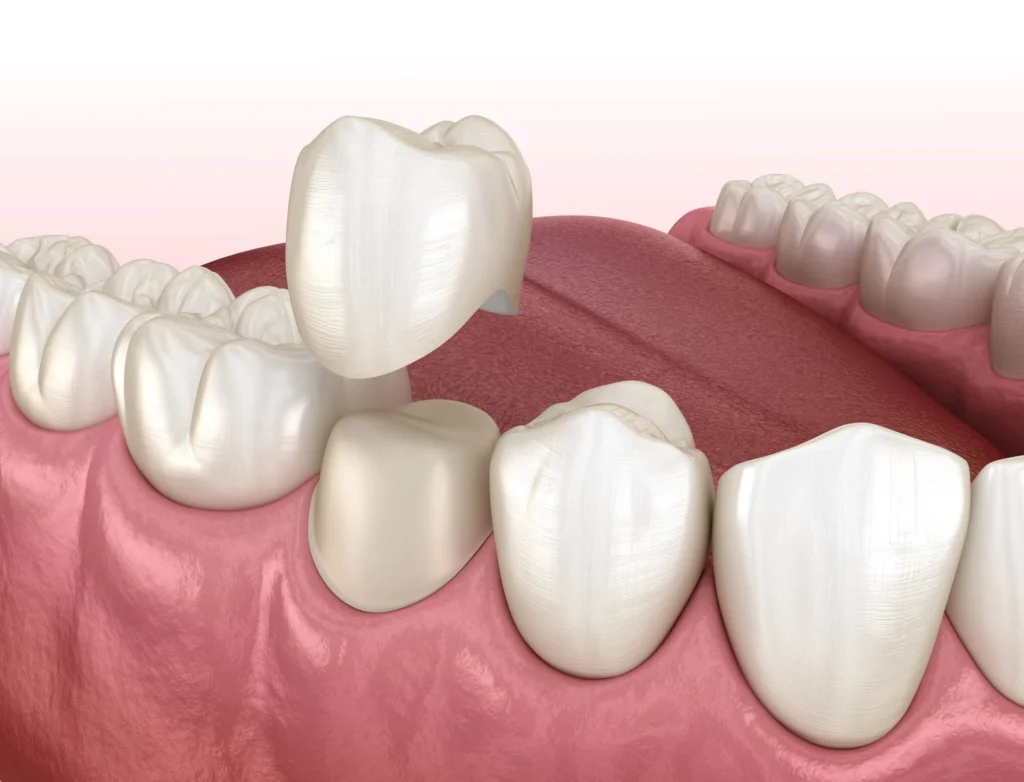 Dental crown illustration by Dentist Rockville MD 