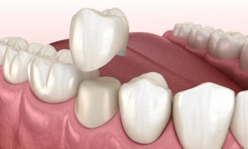 Dental crown illustration by Dentist Rockville MD 