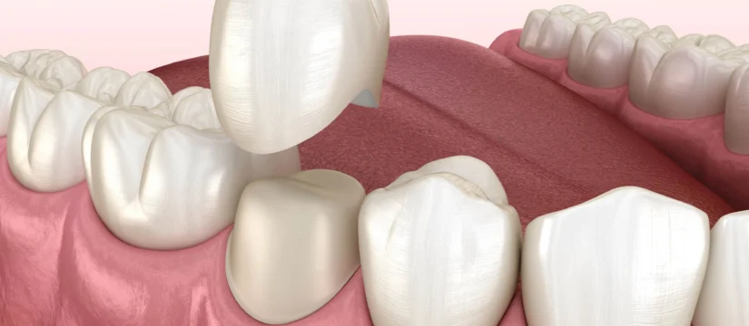 Dental crown illustration by Dentist Rockville MD 
