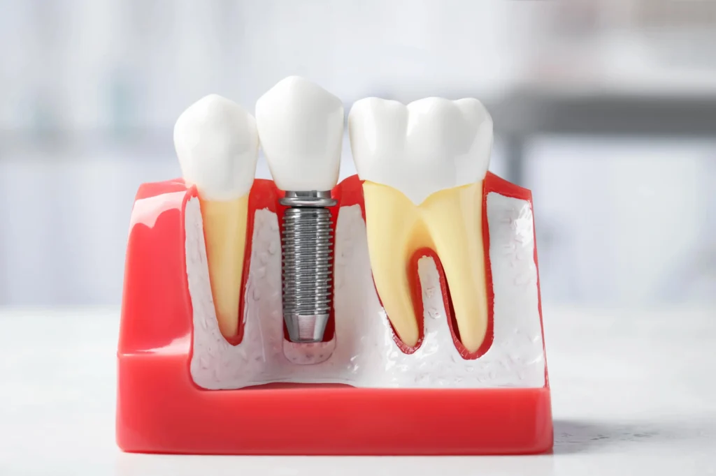 Illustration of dental implants rockville md