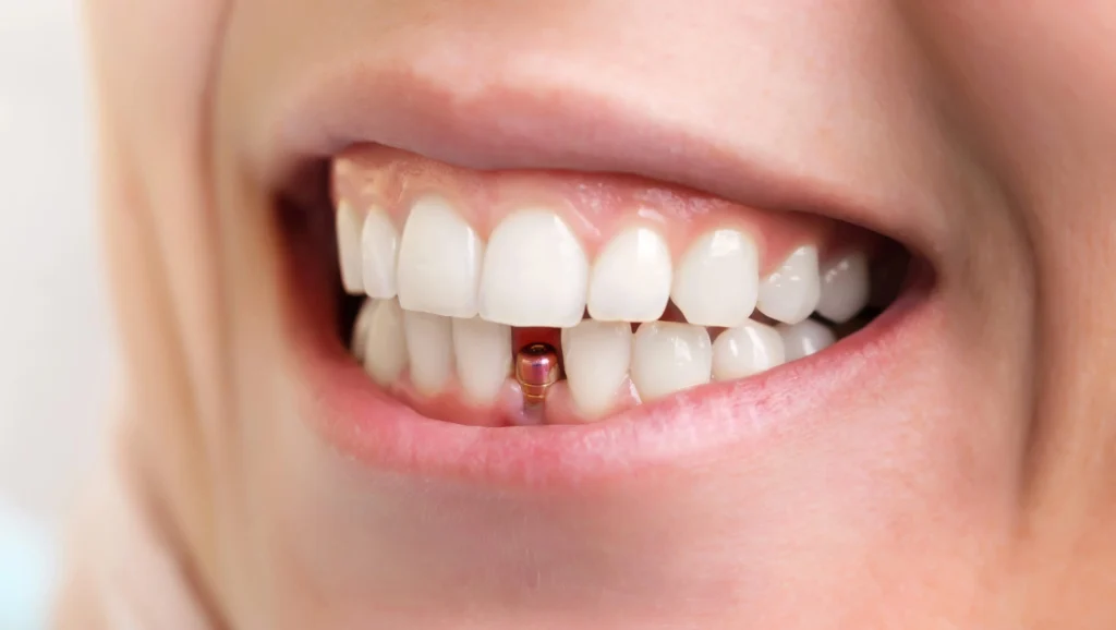 dental implants rockville md