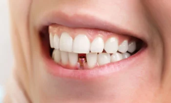 dental implants rockville md 