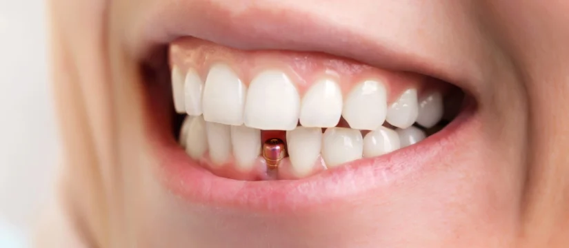 dental implants rockville md 