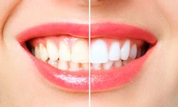 Before and after teeth whitening in Rockville, MD