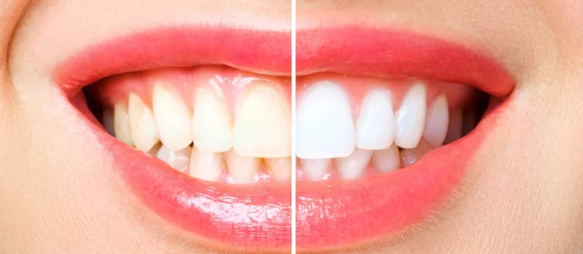 Before and after teeth whitening in Rockville, MD