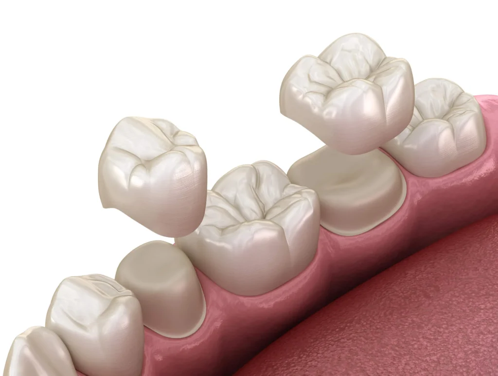 dental crowns rockville md