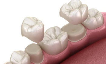 dental crowns rockville md