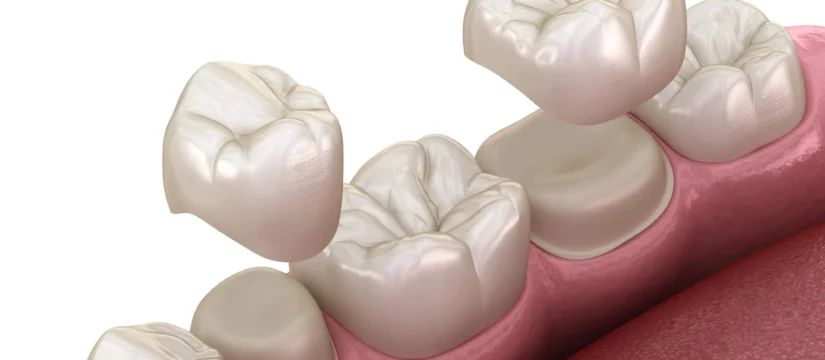 dental crowns rockville md
